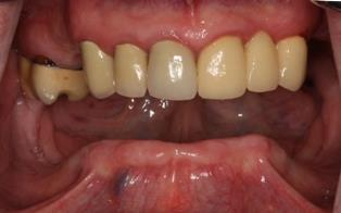 sufficient teeth remain and in these patients no