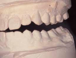 In fact the only parts that really matter are the occlusal contacts that those