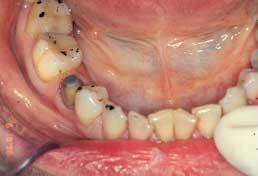 Execute: From an occlusal point of view one of the most significant considerations is the provision of a temporary restoration which duplicates the patient s and is going to maintain it for the