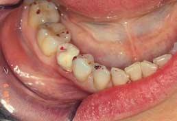 For this the temporary restoration should: be a good fit, so that it is not going to move on the tooth; provide the correct, so that the prepared tooth maintains its relationships; be in the same
