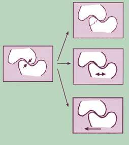 mouth. This means the elimination of incline contacts. Incline contacts are considered to be potentially harmful, because of the lateral force that they may generate.