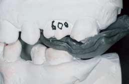 occlusal contacts that the teeth make.