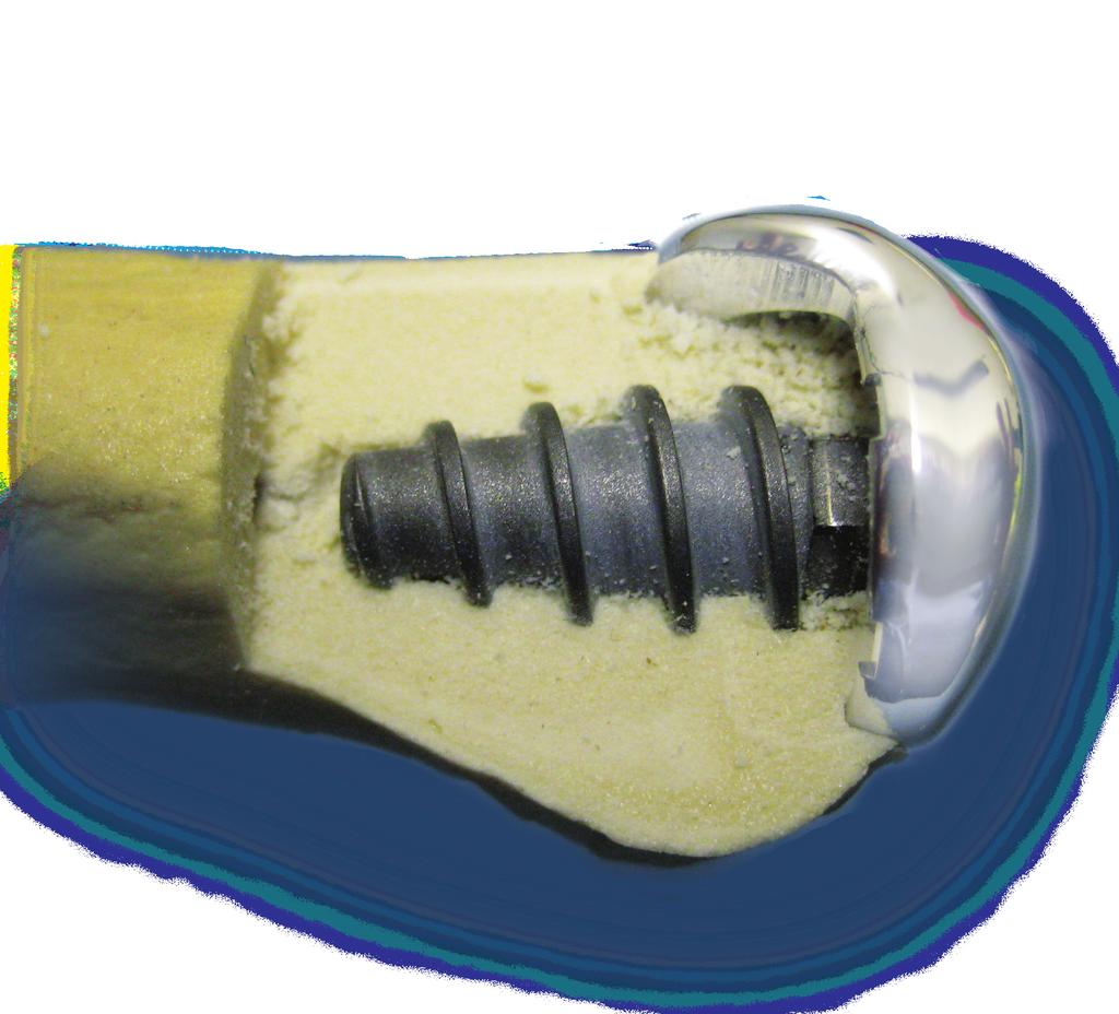 Dual MTP implant curvatures improves dorsal roll-off