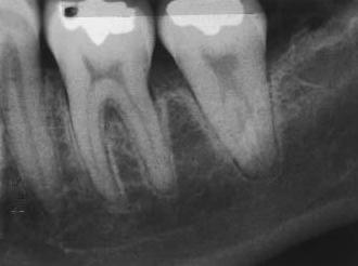 Pathologic occlusion: It is the occlusal relationship that is capable of producing pathologic changes in the stomatognathic system. Also known as traumatic occlusion.