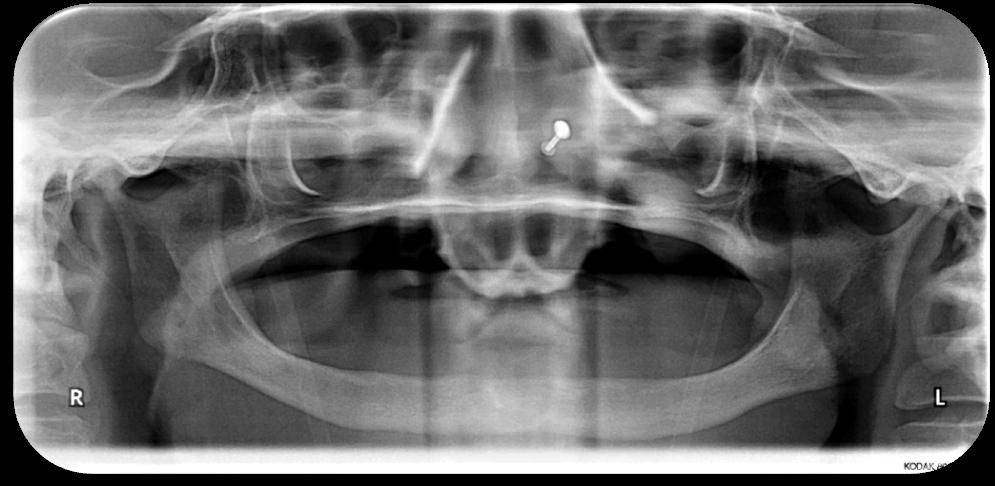 Linear Occlusion consists of following requirements, i.e., Zero Degree Teeth are opposed by Bladed Teeth, Mandibular teeth are set to Flat Occlusal Plane and there are no anterior teeth interferences to Protrusive / Lateral Movement.
