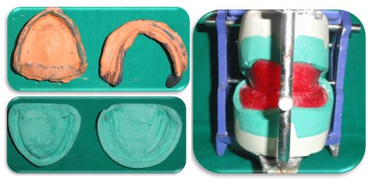 The patient was not willing for an implant supported denture in the present case.