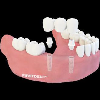 One common way of filling the gap left by a tooth which is removed or falls out is to support a prosthetic tooth by the teeth on each side using a dental bridge.