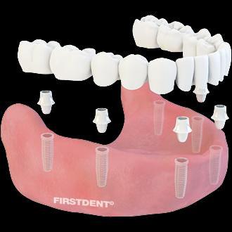 The all on four technique involves 4 implants and a full set of replacement teeth that can usually be fitted in one visit to the dentist.