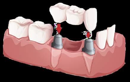 dental implant.