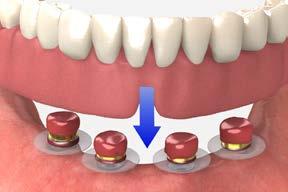 full-arch restorations ball abutment overdenture: chairside pick-up using existing denture 7 Apply the acrylic Use either a chairside light cure acrylic resin or a