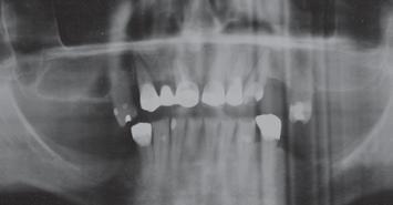 Dan had his maxillary implant procedure in January, which involved extracting all seven remaining teeth and placing two zygomatic and eight Brånemark implants (Nobel