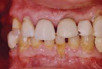 Subsequently, her orthodontic bands had to be prematurely removed. One by one, her teeth required root canal therapy, followed by post/cores and crowns.