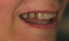 Pre-treatment views of mouth prior to Teeth In An Day treatment made in the mandible, revealing the necessary