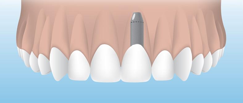 Dental Implants: A Proven Solution to Replace Missing Teeth Dental implants offer a proven, long-lasting, and attractive solution to solve the problem of missing teeth!
