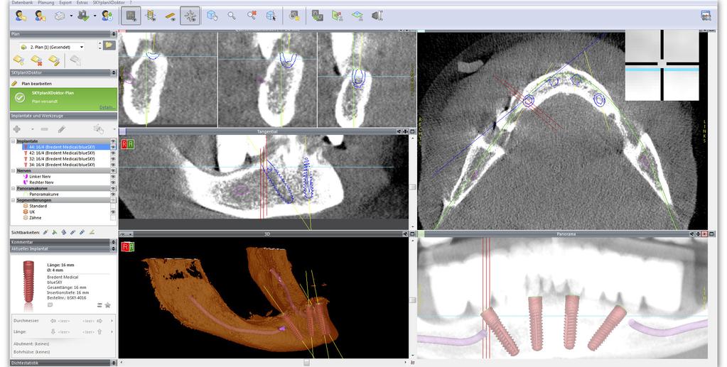 CLINICAL EXCELLENCE Figure 5: Virtual positioning of the implants taking into account the prosthetic possibilities and the