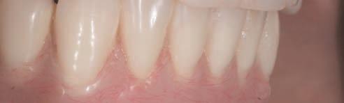 A patient presented seeking replacement of her existing restorations. These restorations had been fabricated according to the all on 4 protocol.