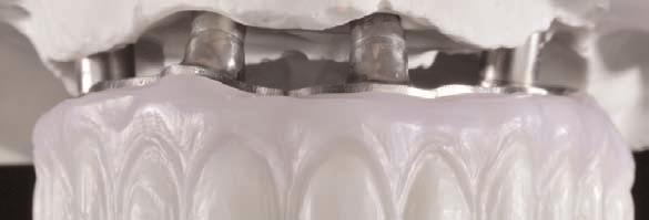 Within the zirconia substructure are titanium inserts so when torque is applied it is distributed to the titanium inserts rather than the zirconia.