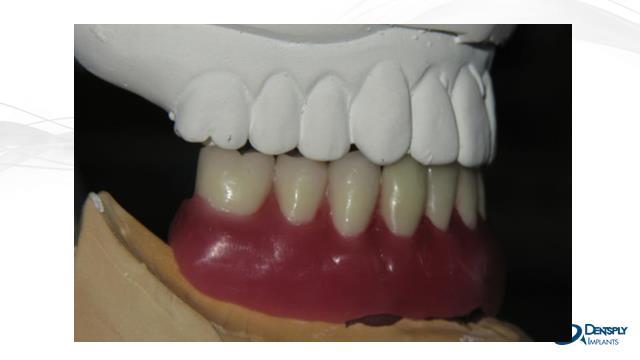 Figure 14 Teeth in wax Appointment 3 Wax Try-In The clinician will try-in the denture set up and confirm both esthetics and occlusion.