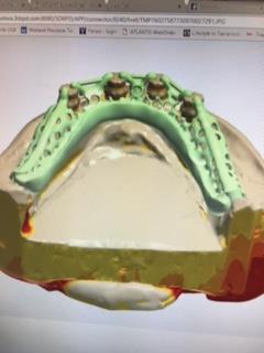 of the denture with metal re-inforcement.