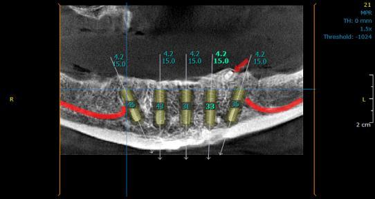 Figure 4 CBCT with implant planning Surgical Phase A minimum of five (5) dental implants are recommended in the maxilla and four (4) dental implants in the mandible.