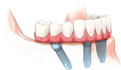 We have good news Your time with dentures or failing dentition can soon be over; you can regain the smile of a The All-on-4 treatment concept The All-on-4 treatment concept is a proven dental implant