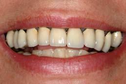 Aesthetic Gum Replacement For good aesthetics in a smile there needs to be harmony between the teeth, gums and the lips.