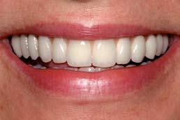In such cases, aesthetic gum replacement is the only predictable way to restore healthy proportions and harmony required for a natural looking smile.