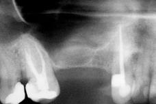 SPACE The graft materials most commonly used are synthetic or bovine bone substitutes, or autogenous bone (patients own bone) that is often harvested from within the oral cavity.