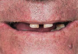 GALLERYGALLERY PROBLEMS Worn Teeth Missing Teeth