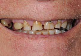 LOWER All-On-4 Plus rehabilitation with bone grafting,