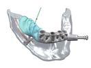 Restorations for the edentulous For edentulous patients, we offer a broad range of removable and fixed solutions, supported by implants, for any kind of indication