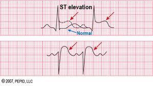 The twelve lead ECG is central to diagnosis of MI because ST
