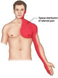 Typical Symptoms Pain centre of chest radiating to the arms, back, neck jaw