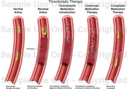 Thrombolytic therapy intravenous infusion