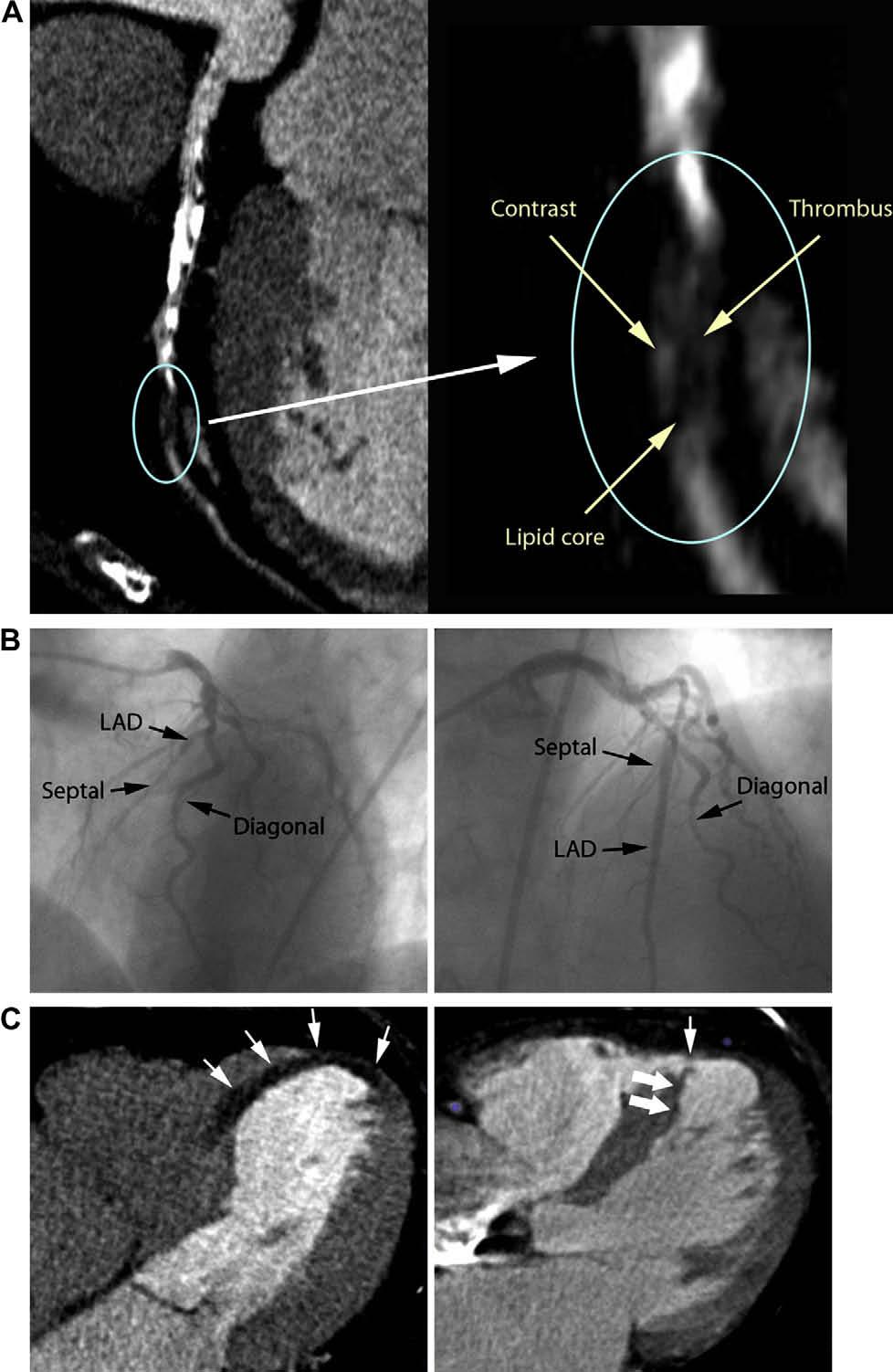 274 Journal of Cardiovascular Computed Tomography, Vol 3, No 4, July/August 2009 Figure 2 CCTA and catheter-based angiography: totally occluded left anterior descending (LAD) artery.