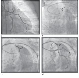 Study on Primary Percutaneous Coronary Intervention (PCI) in Patient AQM Reza et al. Table III Mode of presentation in our hospital Cardiogenic Shock IABP Acute Ant MI 12 (40%) 2 (6.7%) Ac.