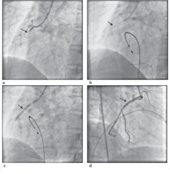 Cardiovascular Journal Volume 2, No. 2, 2010 Fig.-3: Primary PCI in Proximal RCA in a patient with acute Inferior Myocardial Infarction. 3a.