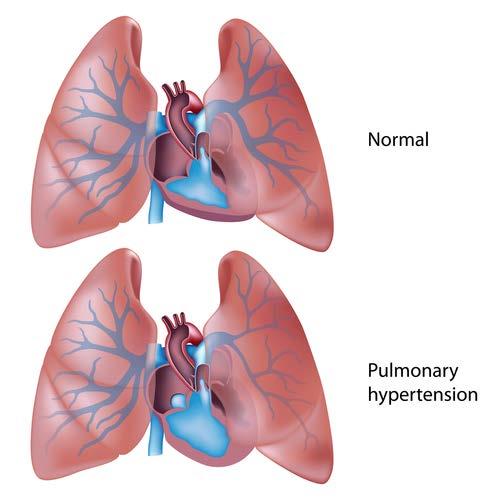 Coding Guideline Updates Pulmonary HTN Pulmonary Hypertension Pulmonary hypertension is classified to category I27, Other pulmonary heart diseases.