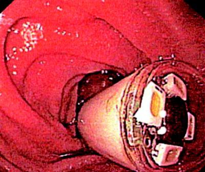 Occult and Overt GI Bleeding: Small Bowel Imaging Lauren B.