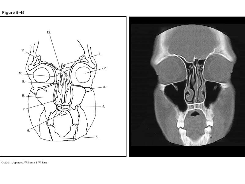 40. Which of the following is illustrated by #10? (Fig. 5-45) A) sphenoid sinus B) ethmoid sinus C) frontal sinus D) none of the above 41.What number illustrates the middle concha? (Fig. 5-45) A) 7 B) 8 C) 9 D) 10 42.