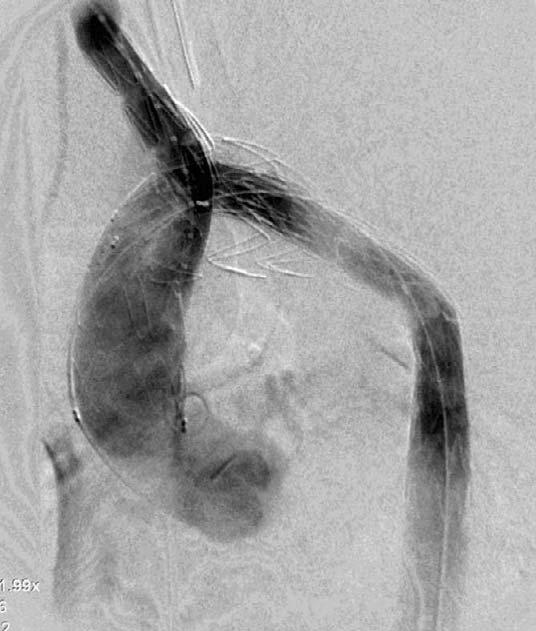 AORTIC ARCH RECONSTRUCTION WITH BIFURCATED STENT GRAFT Figure 5. Follow-up computed tomography shows complete seal with thrombosis in the ascending and descending thoracic aortic false lumen.