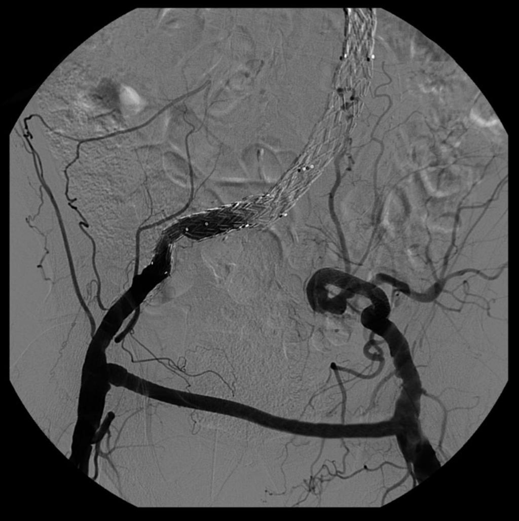 Fig. 4: A volume rendered reformat from a CTA in a 77 year old male with an aorto-biiliac aneurysm. Fig.