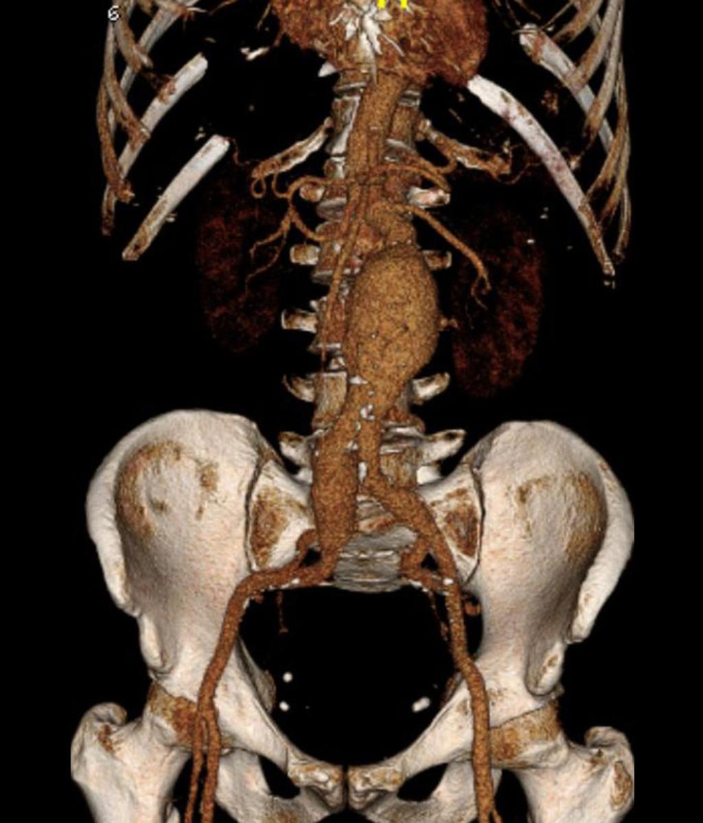 Fig. 8: A volume rendered reformat from a CTA of a 66-year old male with an