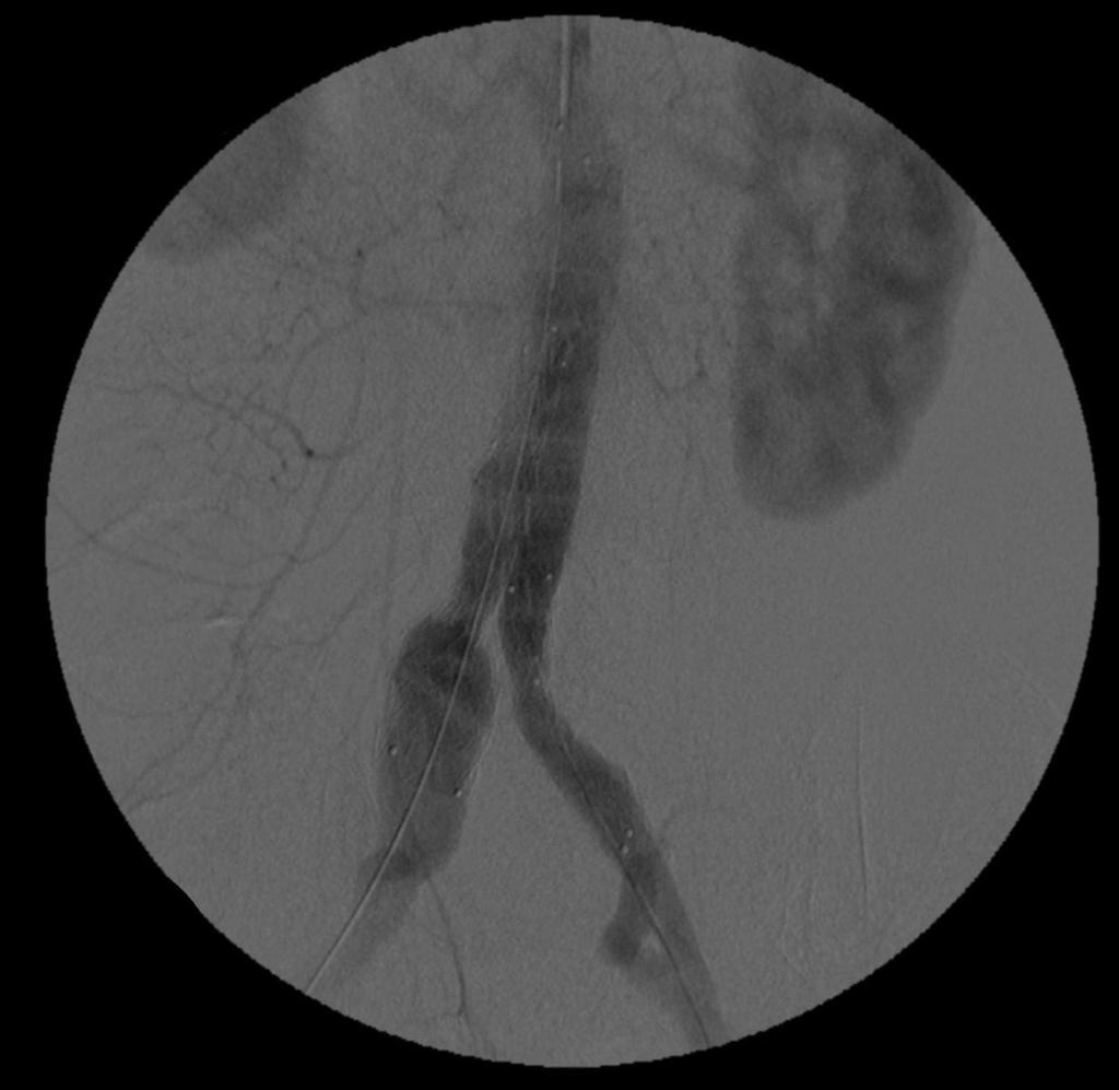 Fig. 9: A completion angiographic image in the same patient following a