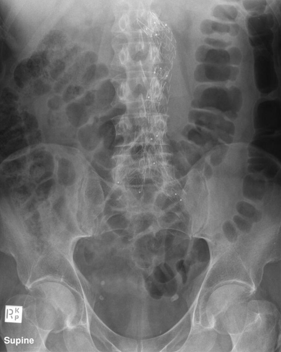 Fig. 10: A plain abdominal radiograph taken after the