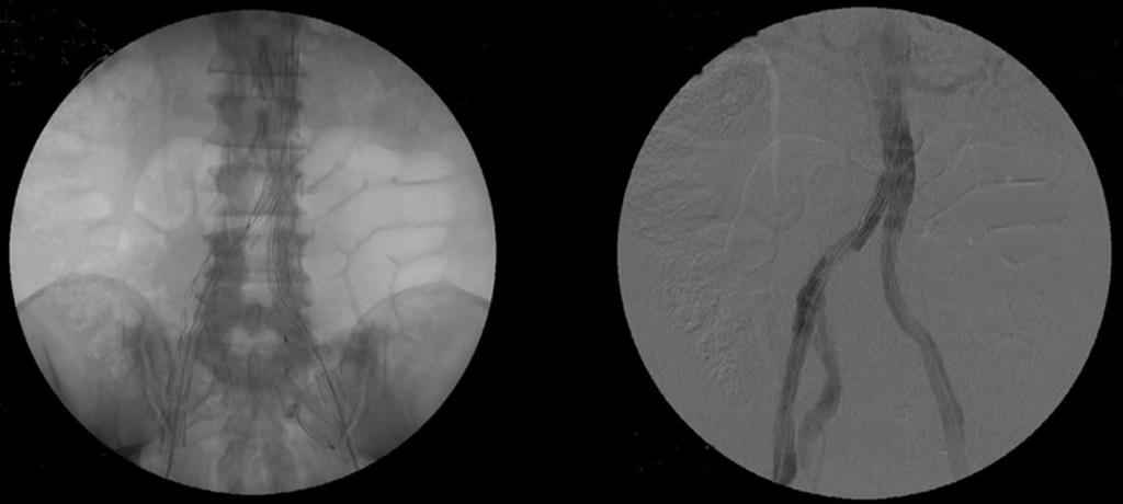 Fig. 15: A native image and the completion subtracted angiogram after deployment of the