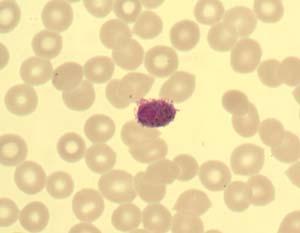 The parasites are amoeboid and the pigment is scattered and fine. The two stages observed were mature trophozoites and gametocytes. The staining quality is good.