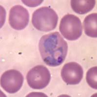 Figure 5 Shows the RBC with ring shape malaria and the extracted malaria parasite 2.