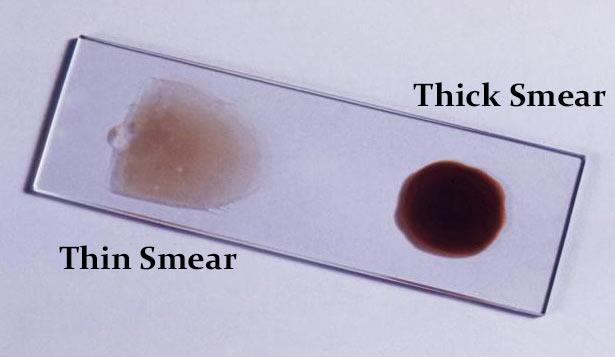 Thin film Slide Preparation One drop of blood (~50uL) near the end Spread the drop using a second slide held at 45 degrees Thick film 1-2 drops of blood should be spread to the size of a dime or