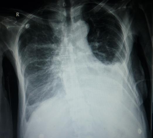Opacity at the left base of the lung